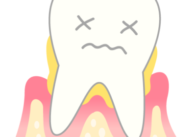 下がり続ける歯茎の原因と対策