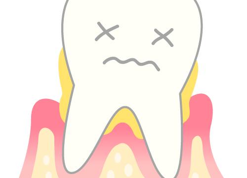 下がり続ける歯茎の原因と対策